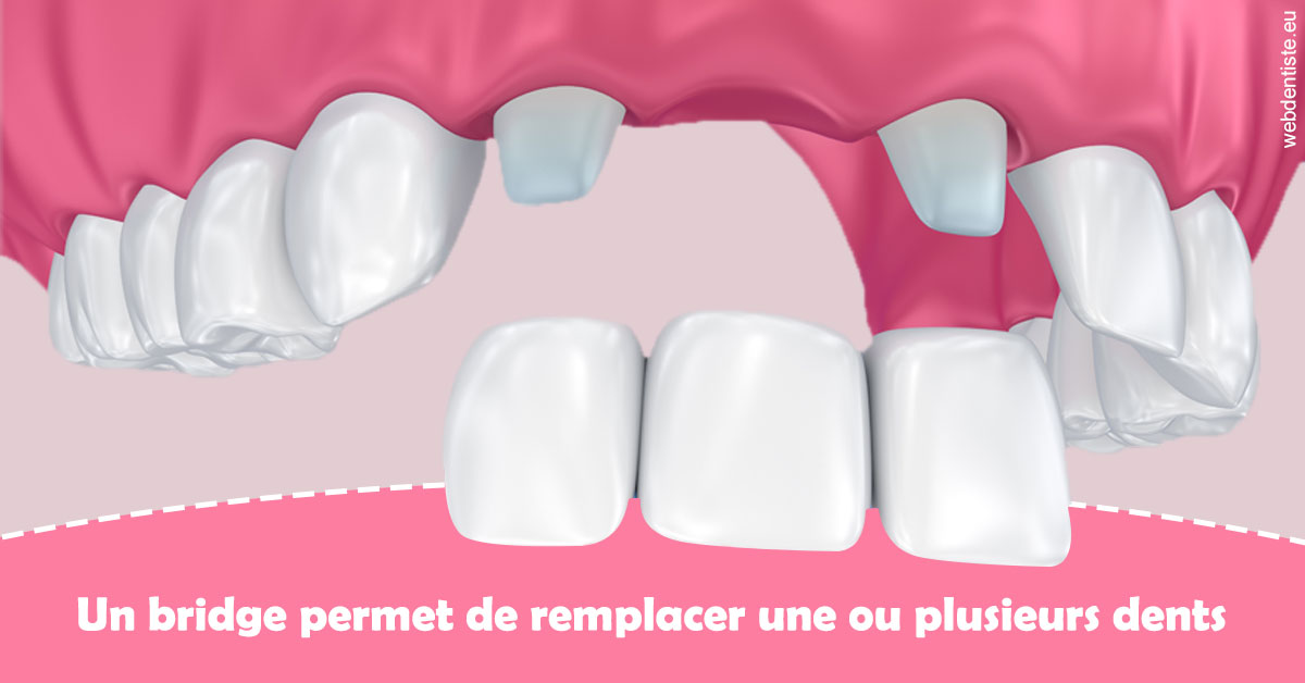 https://www.ortho-brunet.fr/Bridge remplacer dents 2