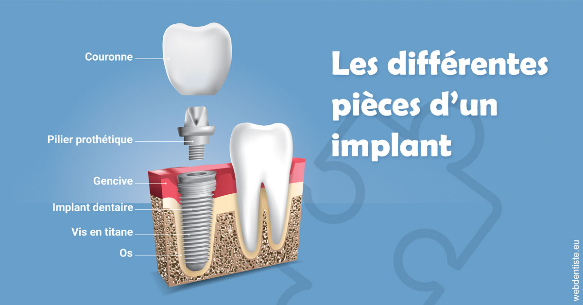 https://www.ortho-brunet.fr/Les différentes pièces d’un implant 1